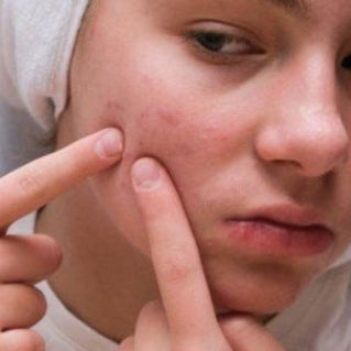 Acne and Breakouts