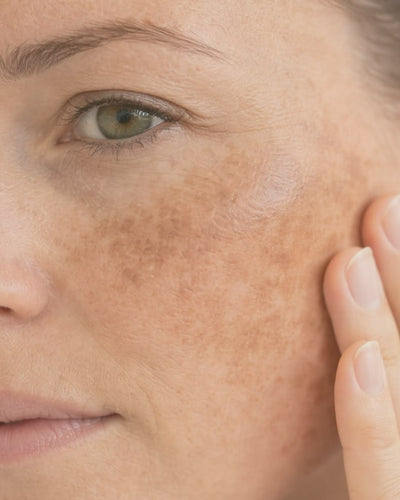 Dark Spots & Marks