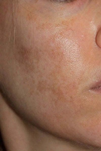 Dull & Uneven Skin