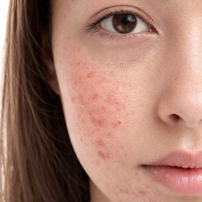 Oily & Acne-Prone